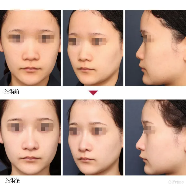 GS 鼻中隔延長術+他院鼻プロテーゼ入れ替え術+眉間プロテーゼ(特別注文プロテーゼ)症例