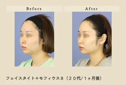 フェイスタイト+モフィウス8