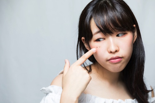 ほくろ除去の6つの失敗例｜原因・対処法・失敗しないためのポイントを紹介