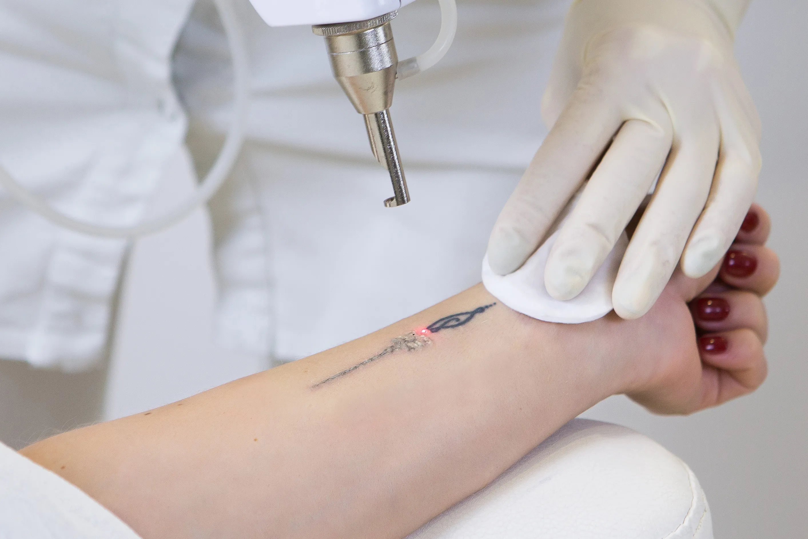 【福岡】タトゥー除去のおすすめ美容外科9選！名医・口コミ・費用も紹介